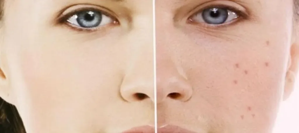 Sivilce Neden Olur ve Nasıl Geçer